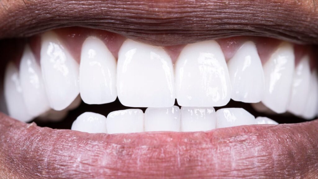 What is a calculation of cucrize? And how to prevent your teeth